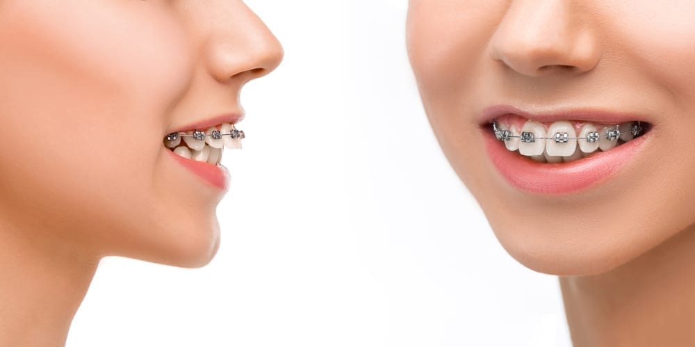 5 Symptoms Indicating You Need Braces Orthodontic Arts