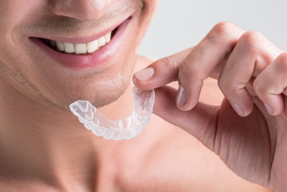 clear aligners