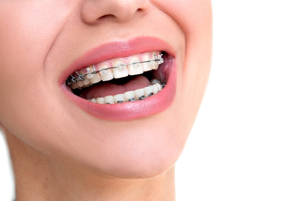 Damon Braces