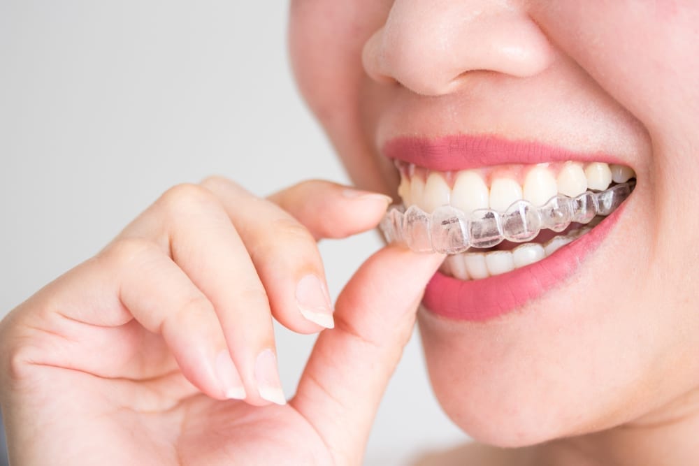 Orthodontic Arts answers the question of; is Invisalign worth it?