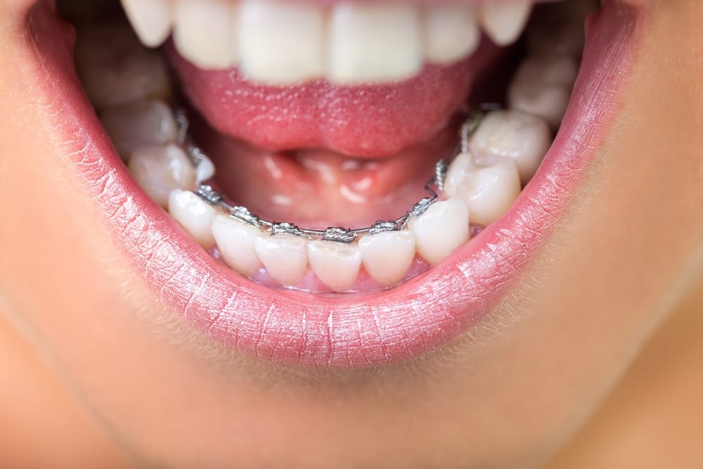 Learn about the lingual braces food restrictions list.