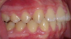 A photo of the alignment after using the Herbst Appliance from Orthodontic Arts OKC.