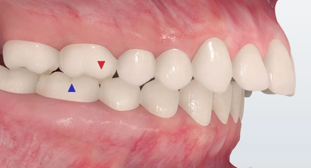 A photo of an overjet that needs the herbst appliance from Orthodontic Arts OKC.