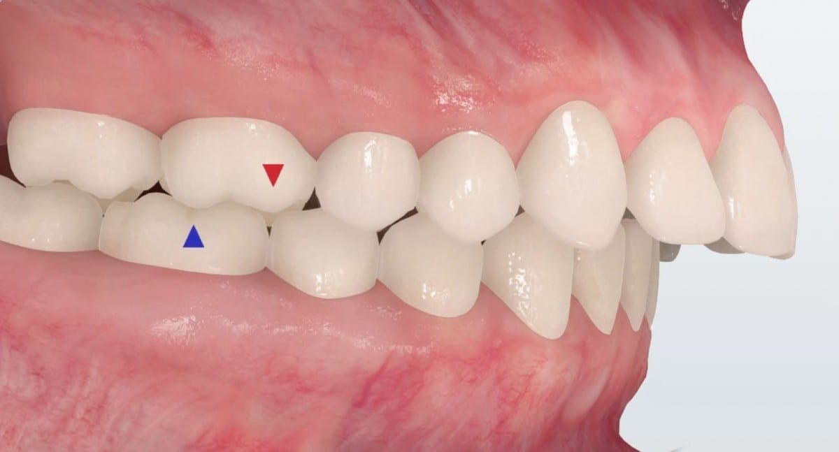 The Benefits of Using Herbst Appliance with Braces