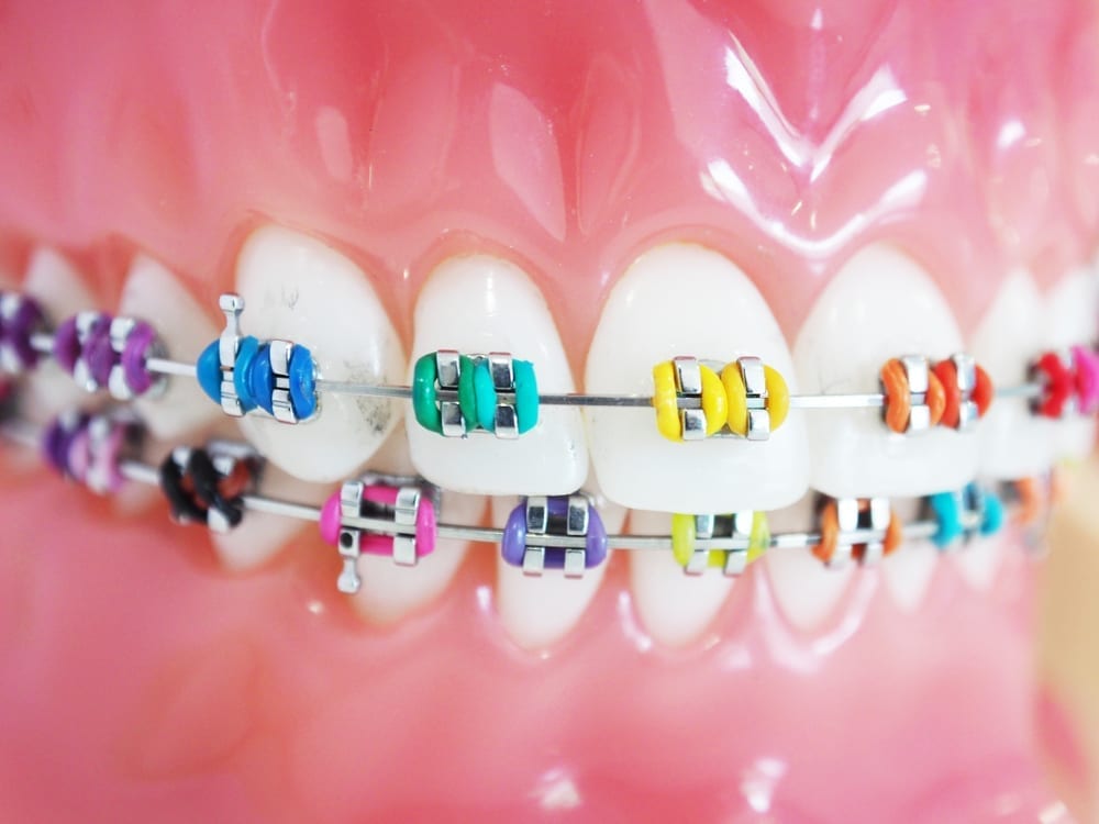 clear braces with purple bands