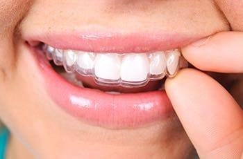 Orthodontic Art shows a photo of Invisalign for teeth straightening.
