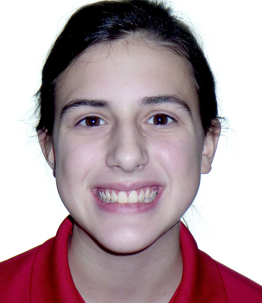 patient-1-after-smile