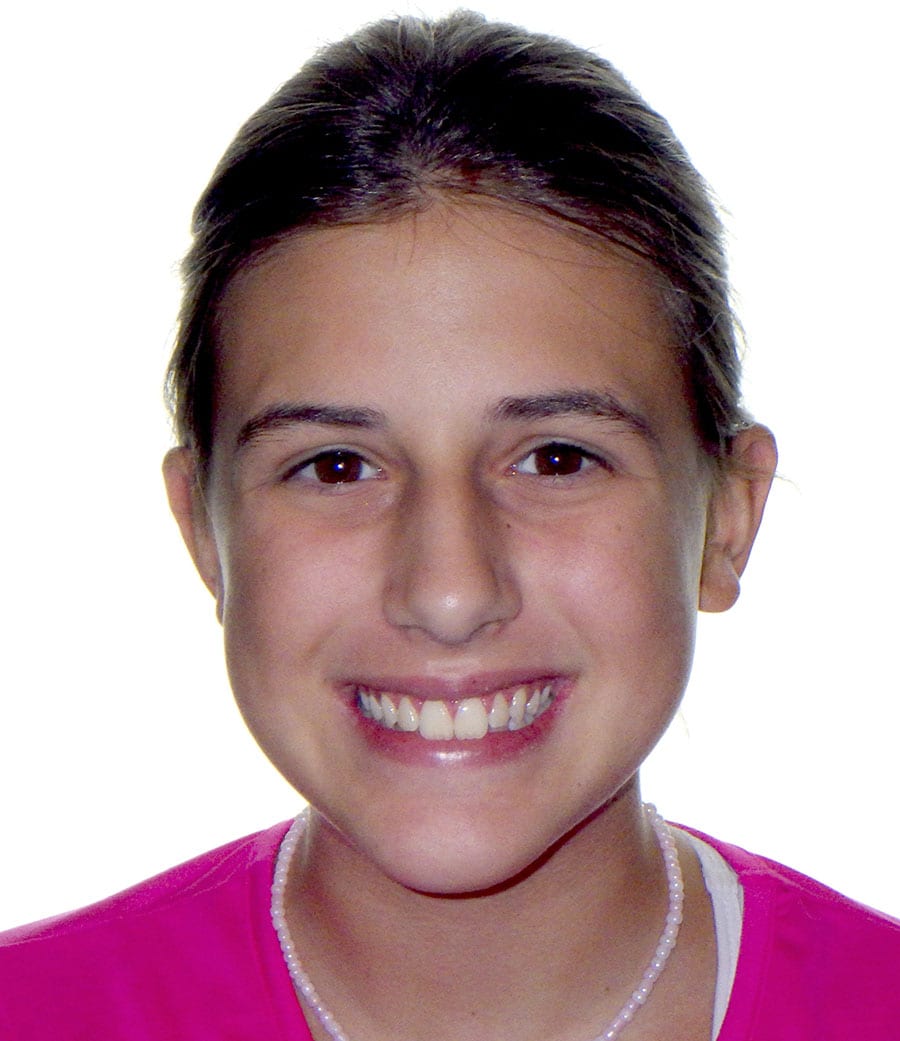 patient-1-before-smile