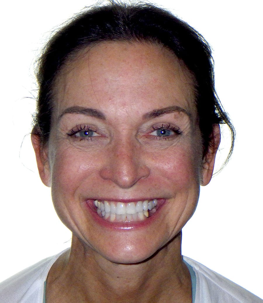 patient-2-before-smile
