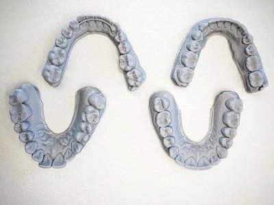 nudge aligner system at Orthodontic Arts