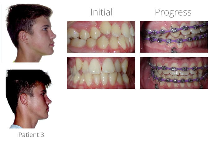 class 3 correction surgery
