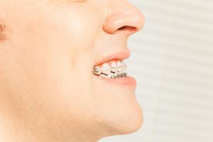 an overbite is one of the different types of bites in teeth 