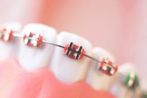 pink braces to help with the different types of bites in dentistry 