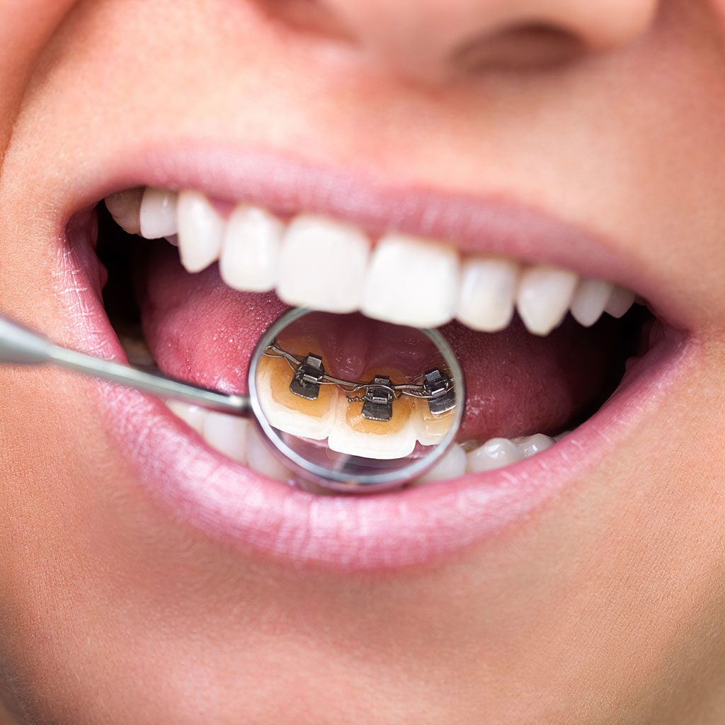 lingual braces in the mouth looking through an orthodontist mirror