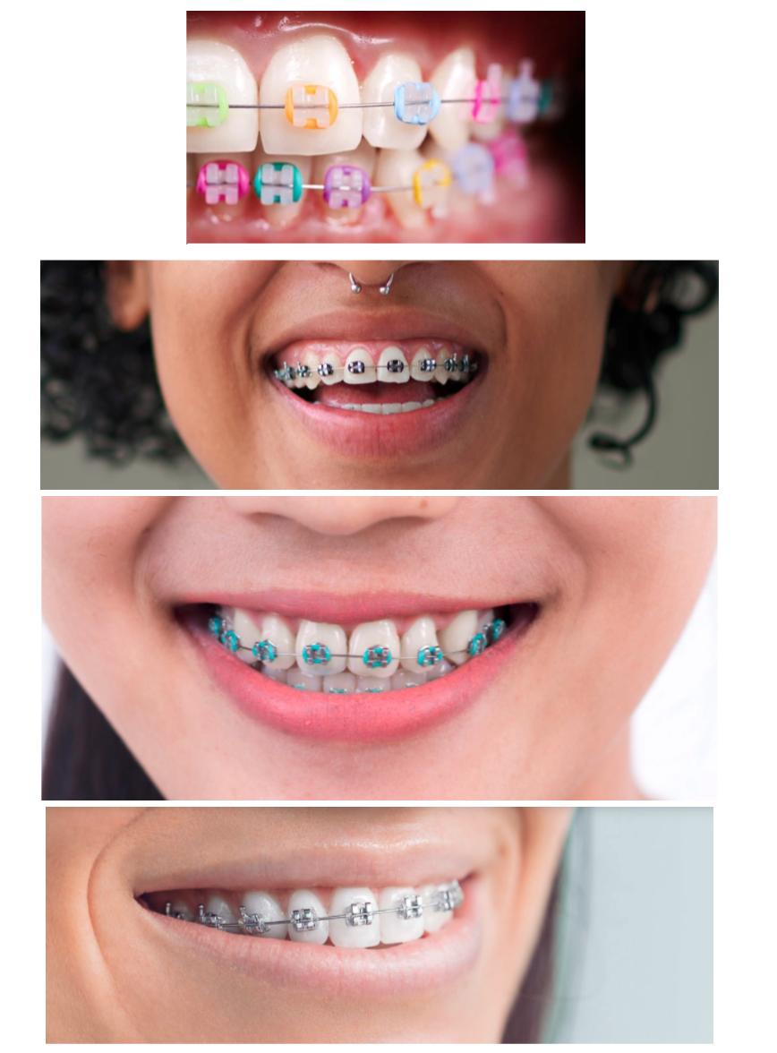 Good Colors for Braces. Braces Color Ideas.