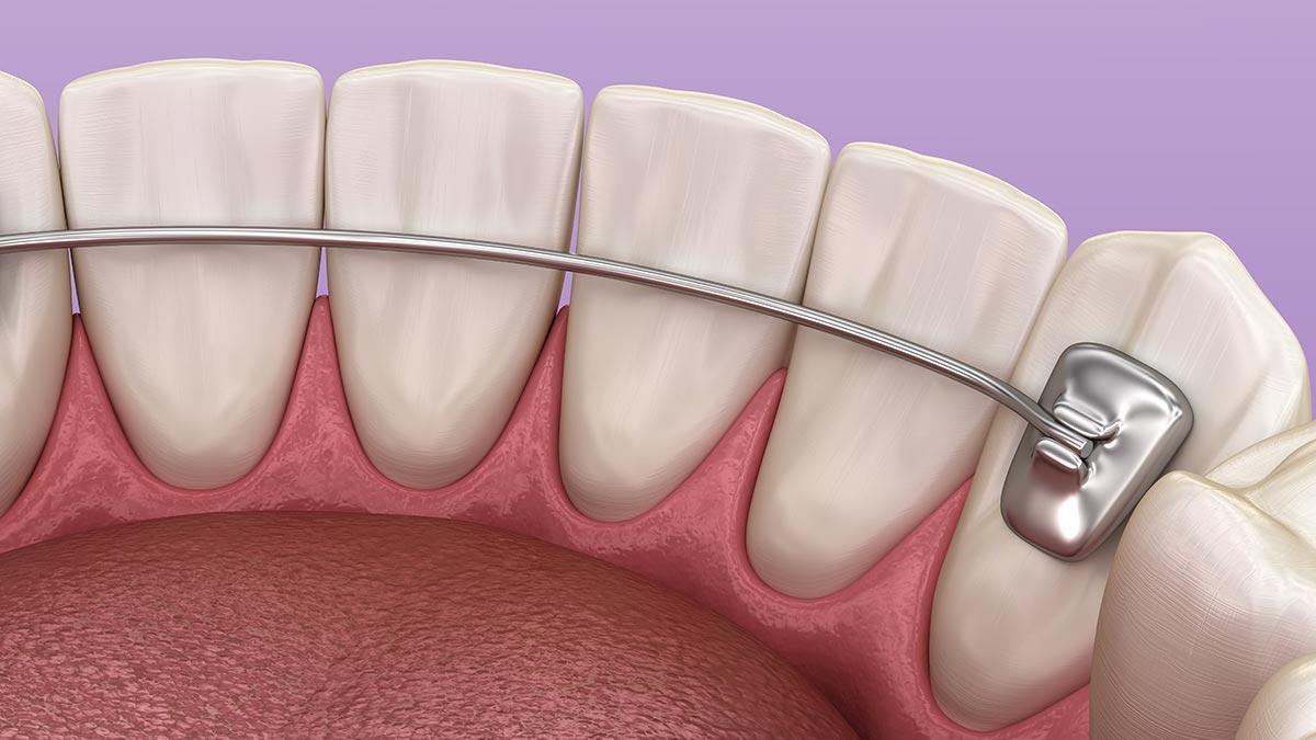 Teeth Straightening After Braces Permanent Retainer.