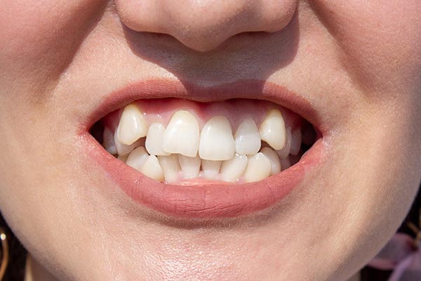 Permanent Retainer 8 Things To Know Orthodontic Arts