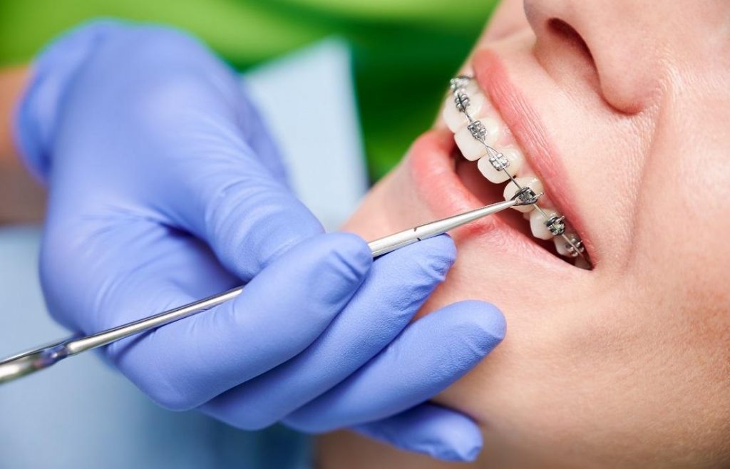 Getting Braces Off Teeth After Braces Orthodontic Arts OKC Getting Braces Off Teeth After Braces Orthodontic Arts OKC