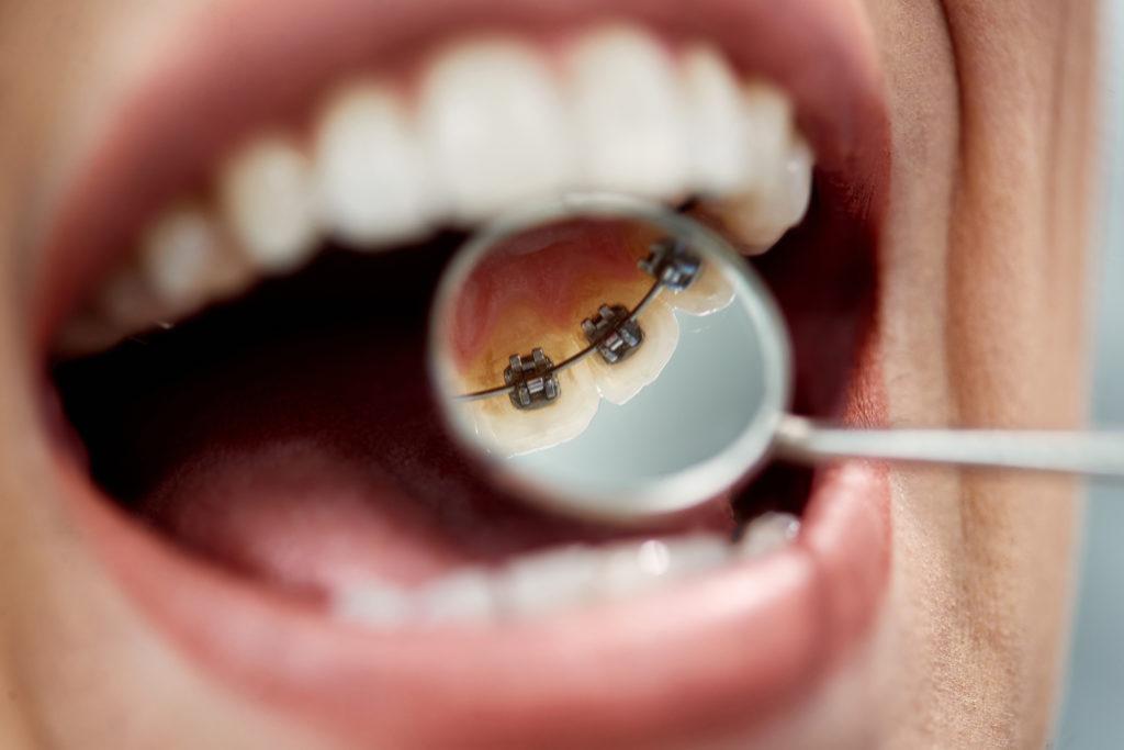 Can You Get Braces on Back of Teeth?
