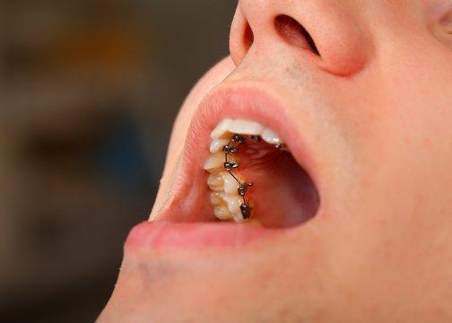 Do Braces on Back of Teeth Work?