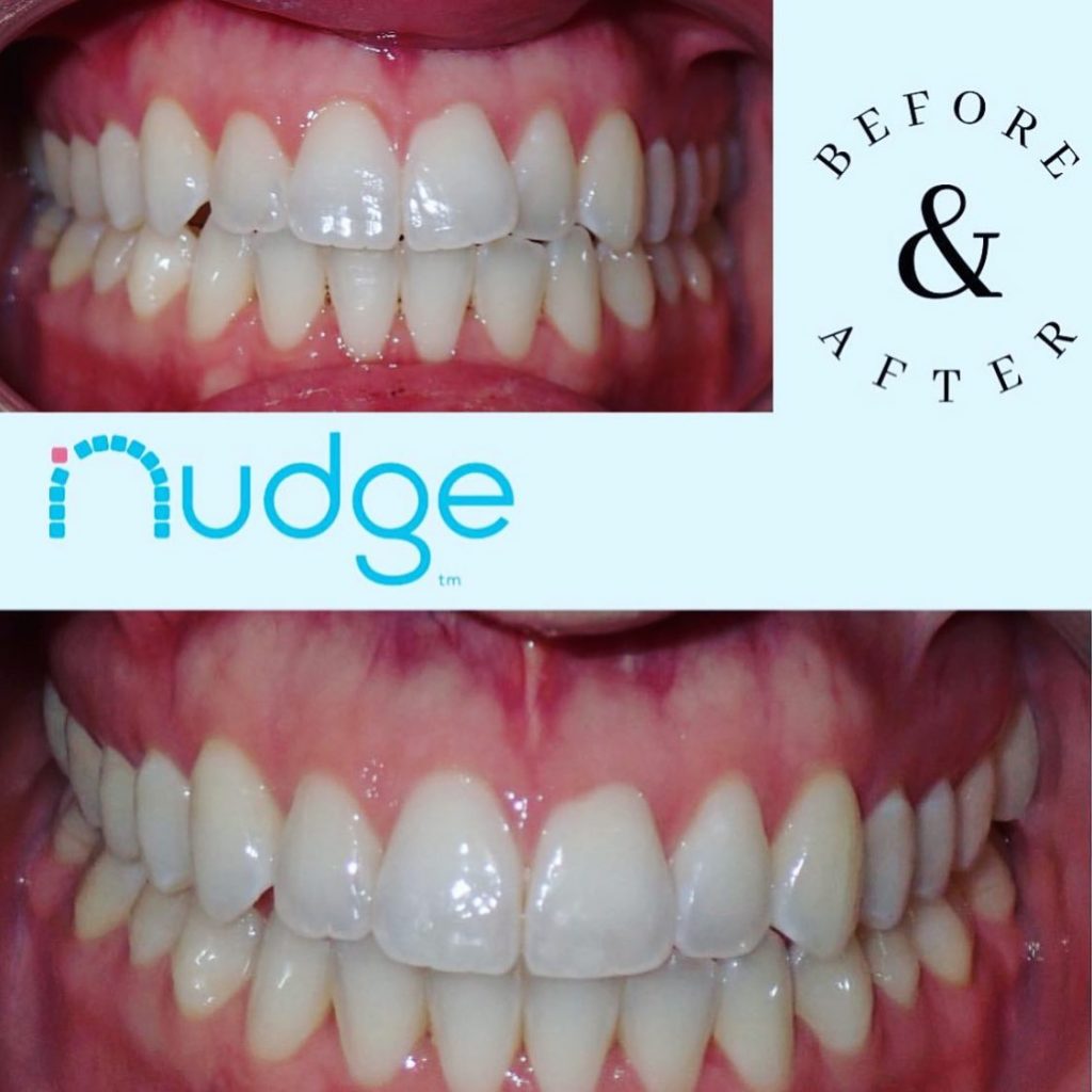 Before and After Clear Aligners for Teeth Treatment.