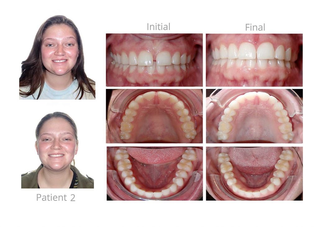 Smile Direct Club Closed Clear Aligner Treatment Alternative Nudge Orthodontic Arts.